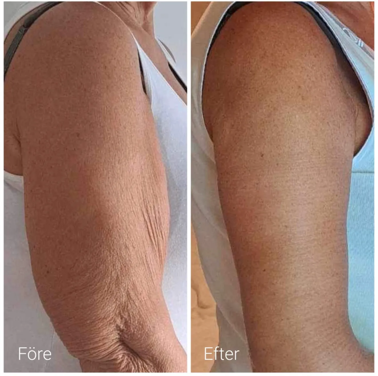Före- och efterbild av armplastik utförd på Beauty@Home