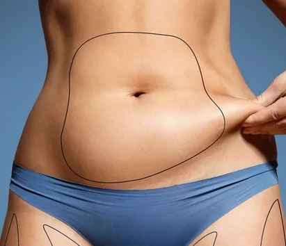 Överskottshud på magen som kan åtgärdas med bukplastik